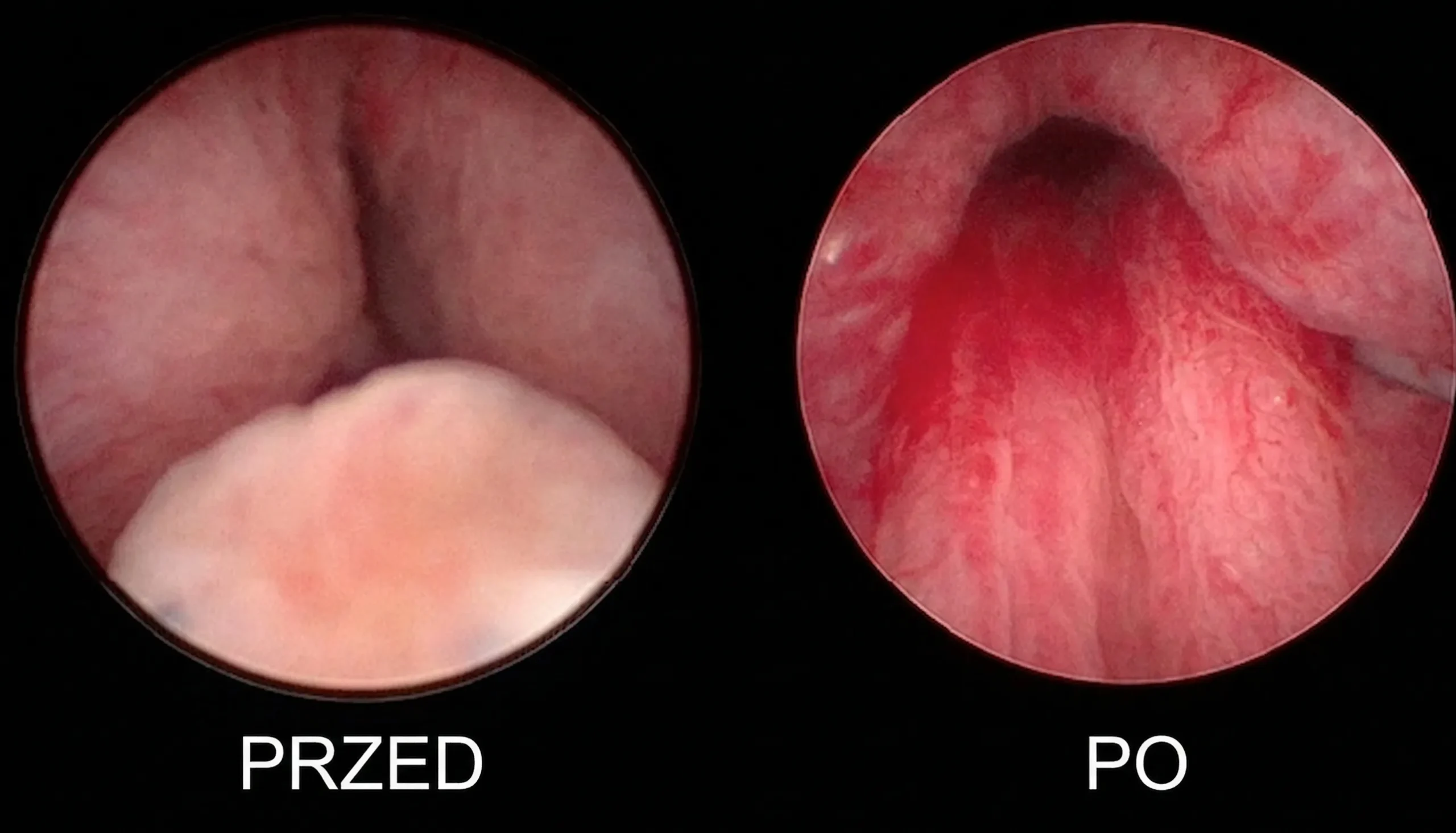 Wizualizacja pokazująca ciągłe piszczenie w uszach i zatkane ucho i szum