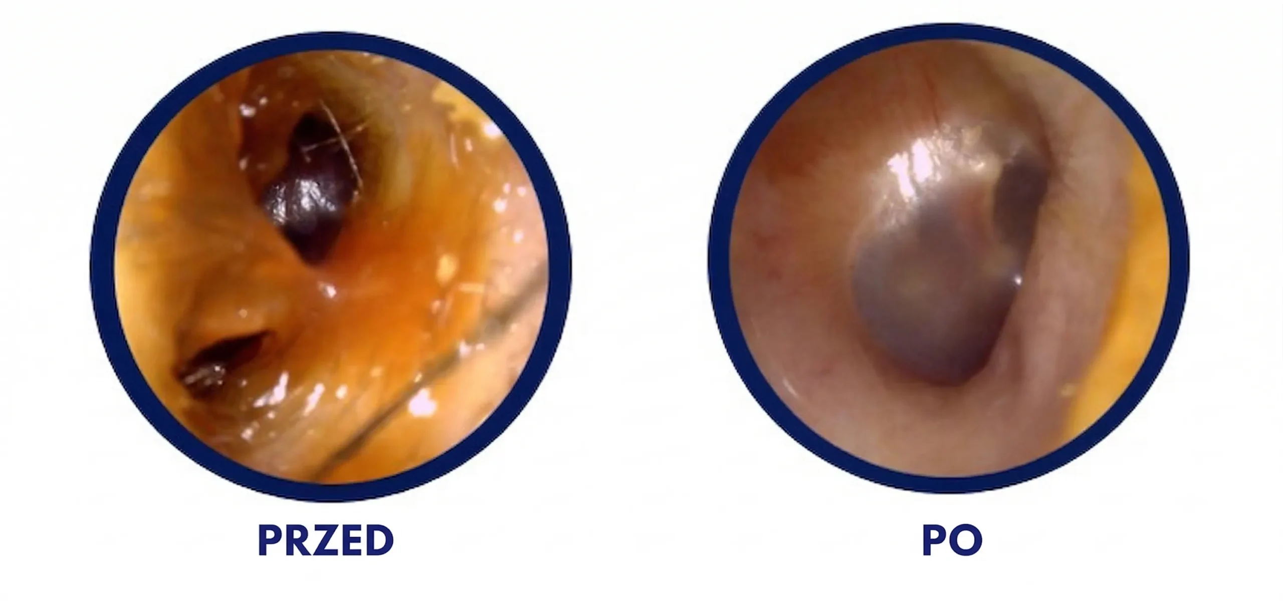 Wizualizacja pokazująca ciągłe piszczenie w uszach i zatkane ucho i szum