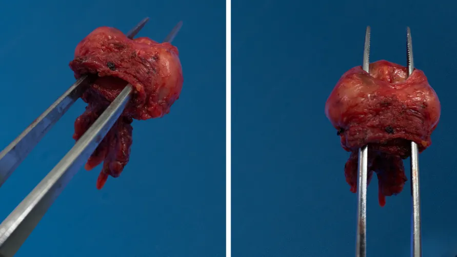 Przed i po leczeniu prostaty