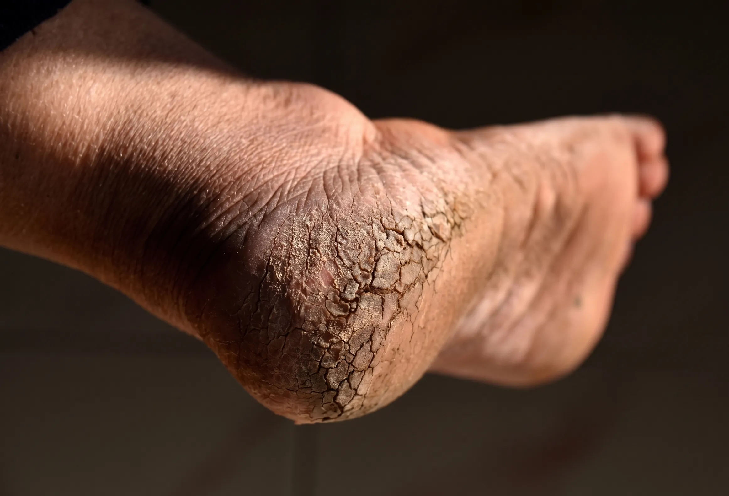 Severe hyperkeratosis on heel