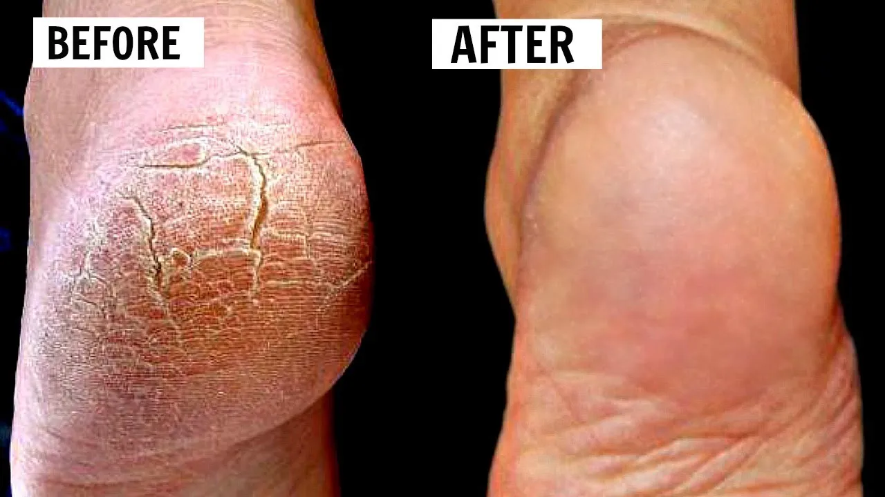 Cracked heel before and after comparison